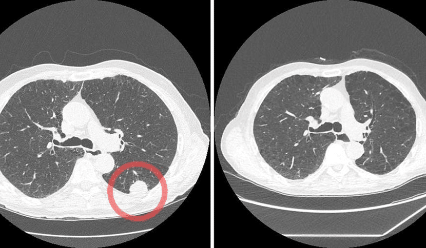 Current / Heavy Smoker? CT Lung Screening Saves Lives