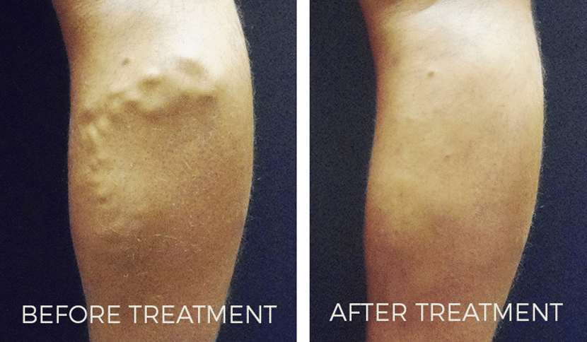 Left leg shows bulging veins before treatment; right leg appears smooth and clearer after treatment.