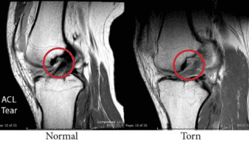 ACL Tear