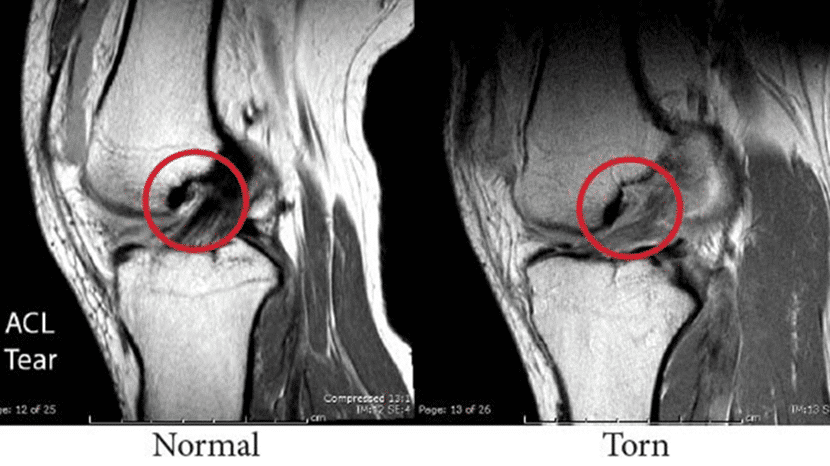 ACL Tear