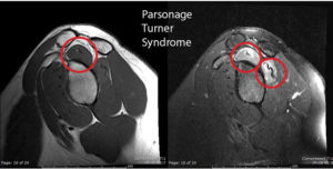 Image 5 - Parsonage Turner Syndrome 2