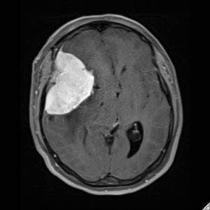 Pre-op brain tumor