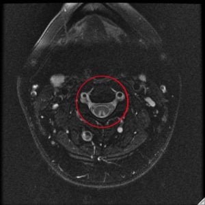 spinal cord injury 1