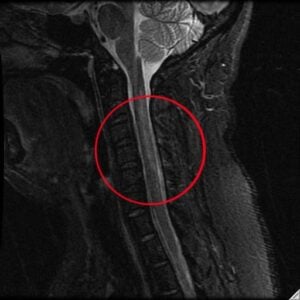 spinal cord injury 2