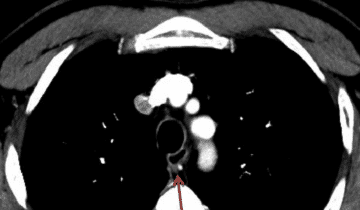 CT Calcium Scoring