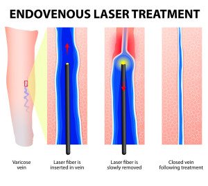 Illustration of Endovenous Laser Treatment (ELVT)