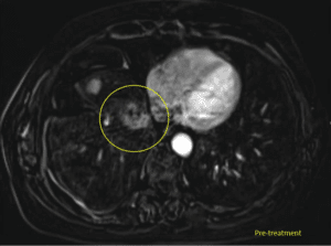 Liver tumor pre-treatment