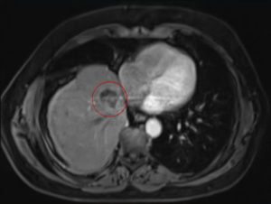 Lung Tumor MRI