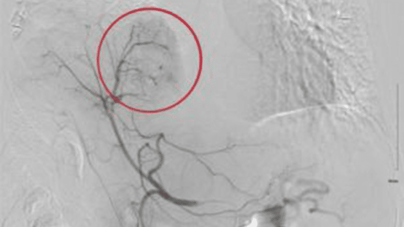 Lung Tumor Procedure