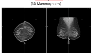 Two 3D mammography breast scans displayed side by side with the title 3D Tomosynthesis above.