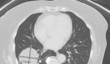 CT scan of a chest showing lungs and heart with measurement markings in the lower left lung area.