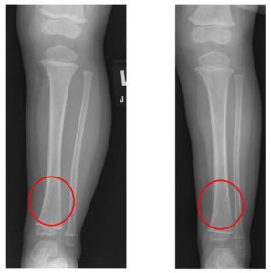 Children's Radiology Leg Fractures X-ray