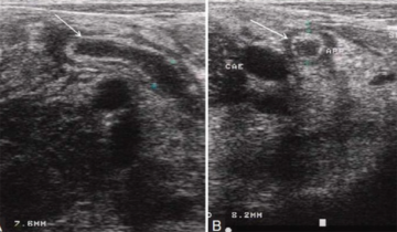 Childs Appendix Ultrasound