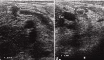 Childs Appendix Ultrasound