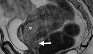 MRI scan showing a large pelvic mass (arrow) with heterogeneous texture; adjacent organ marked by an asterisk.
