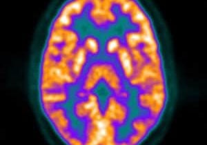 Healthy-Brain-PET-CT