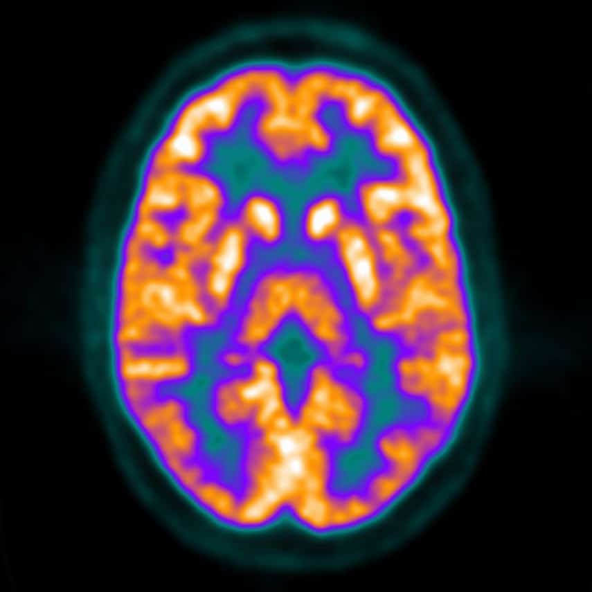 PET, MRI show exercise aids brain health Austin Radiological Association