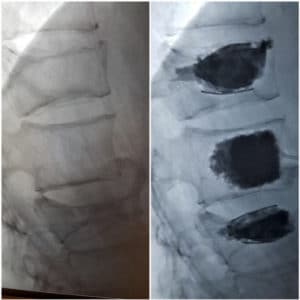 SpineJack insertion improves spinal compression fractures