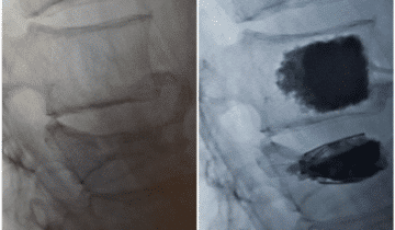 SpineJack before and after spinal fracture