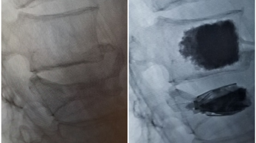 SpineJack before and after spinal fracture