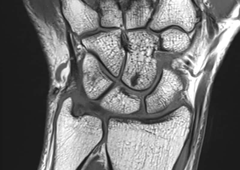 Close-up of a detailed MRI scan image of a human wrist.