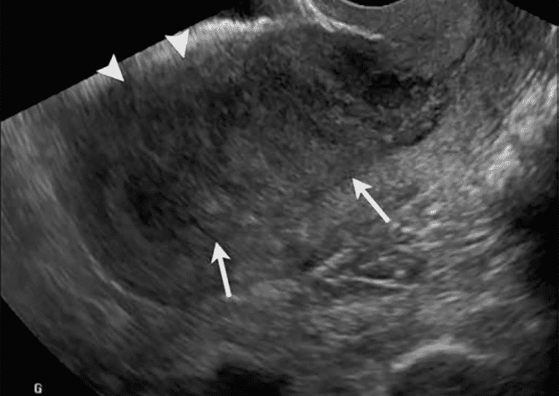 An ultrasound image of a uterus with a thickened endometrium.