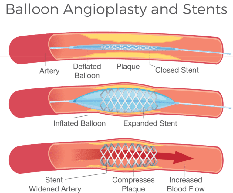 Peripheral Arterial Disease (PAD) ARA Diagnostic Imaging