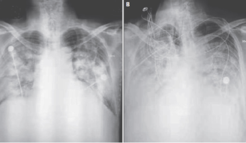 S-ray showing pneumonia caused by coronavirus