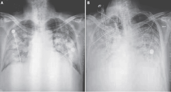 S-ray showing pneumonia caused by coronavirus