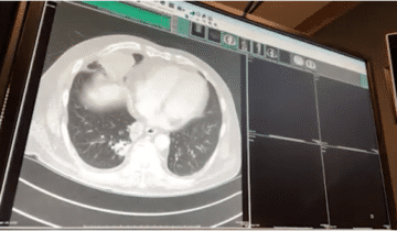 A computer screen displays a chest CT scan image showing lungs and heart in a cross-sectional view.
