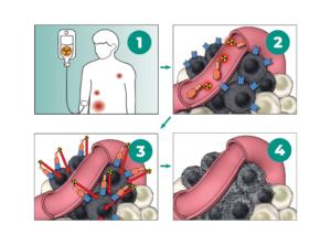 Infographic showing how PSMA (Pluvicto) is infused via an IV, attaches to prostate cancer cells, and delivers radiation.