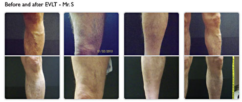 Before and After EVLT - Mr. S