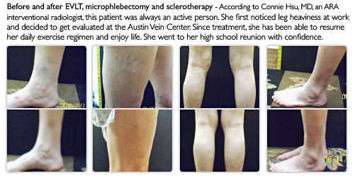 Before and After EVLT - July 22, 2014